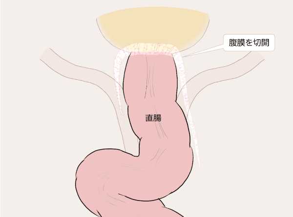 腹膜切開