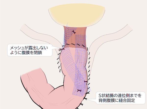 腹膜の閉鎖と高位重積の予防