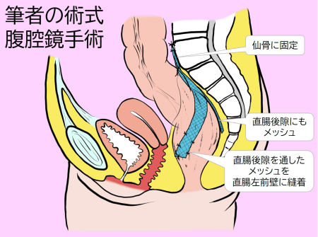 手術の完成図